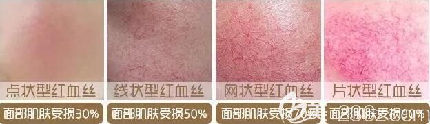 面部出現(xiàn)紅血絲的類型