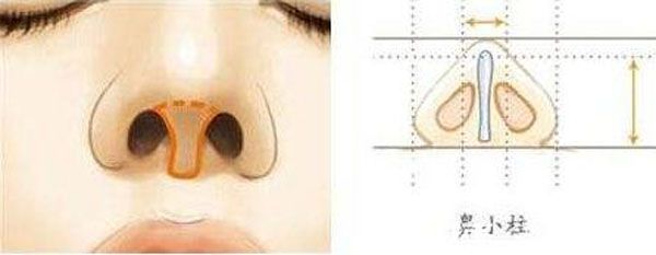 什么是鼻小柱延長(zhǎng)
