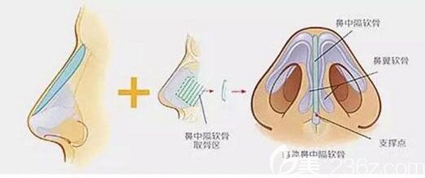 鼻小柱延長(zhǎng)可以用玻尿酸嗎