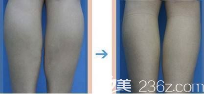 網(wǎng)友私信分享小腿抽脂術后3月無效果的對比照