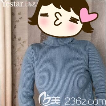 <!--<i data=20240703-sp></i>-->藝星許炎龍曼托假體隆胸真人案例術(shù)后45天