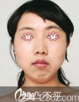 脂肪填充失敗圖之凹凸不平