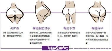 自體脂肪豐臀價(jià)格貴嗎？