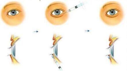 自體脂肪填充臥蠶和術(shù)后護(hù)理有關(guān)