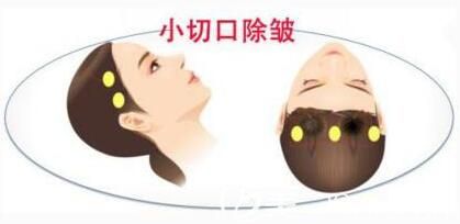 小切口面部提升術(shù)可以維持多久呢？