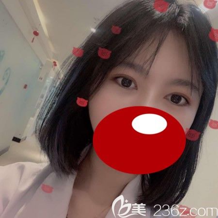 泉州雙眼皮手術(shù)哪家好？我找張慧慧做全切雙眼皮7mm一年后照片分享給大家