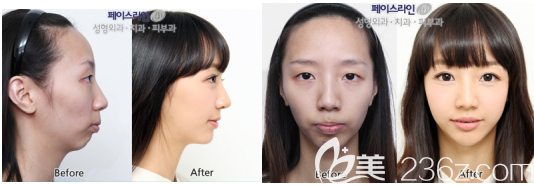 準新娘用她在韓國菲斯萊茵做凸嘴矯正手術(shù)的案例來告訴你這個醫(yī)院怎么樣？