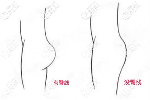 大腿吸脂后有臀線和沒(méi)有臀線的區(qū)別對(duì)比圖