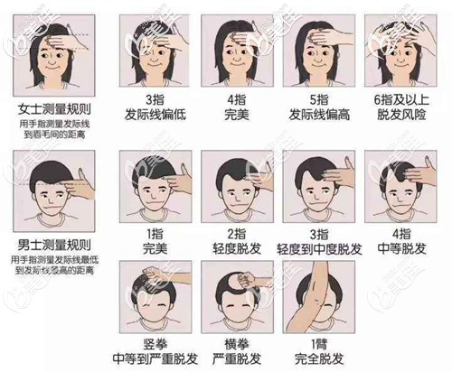 發(fā)際線脫發(fā)等級(jí)自測(cè)圖 發(fā)際線脫發(fā)等級(jí)自測(cè)圖