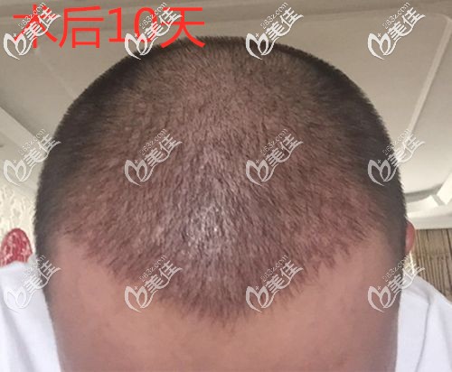 加密植發(fā)10后長出了新發(fā)茬