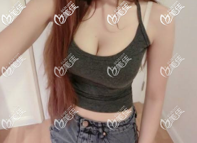 西安高一生自體脂肪隆胸術(shù)后兩個(gè)月的樣子