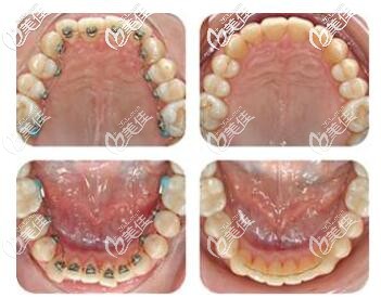 舌側(cè)隱形矯正