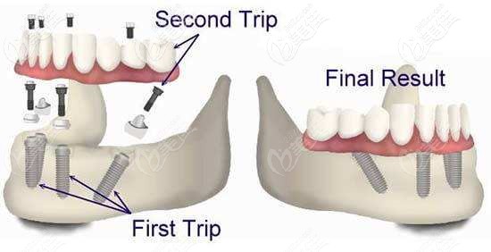 全口種植牙的價格差異介紹