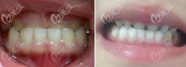 乳牙反頜 乳牙反頜