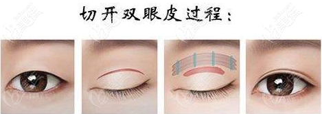 切開(kāi)雙眼皮手術(shù)過(guò)程圖