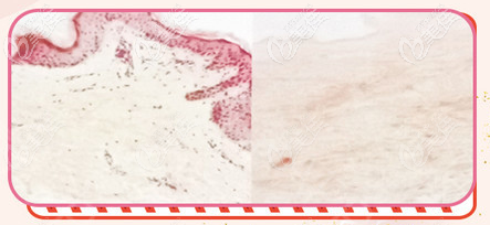 3D生物束帶產(chǎn)生無(wú)細(xì)胞殘留的組織支架