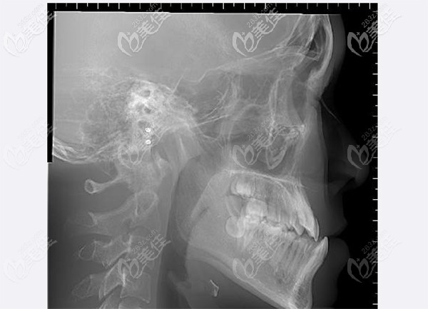 兒童牙齒對刃，反頜情況明顯