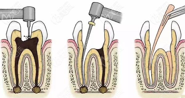 南京做一次性根管治療的費(fèi)用 南京做一次性根管治療的費(fèi)用