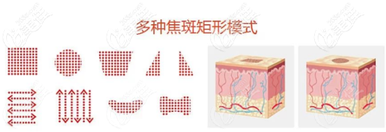 二氧化碳激光的治療模式