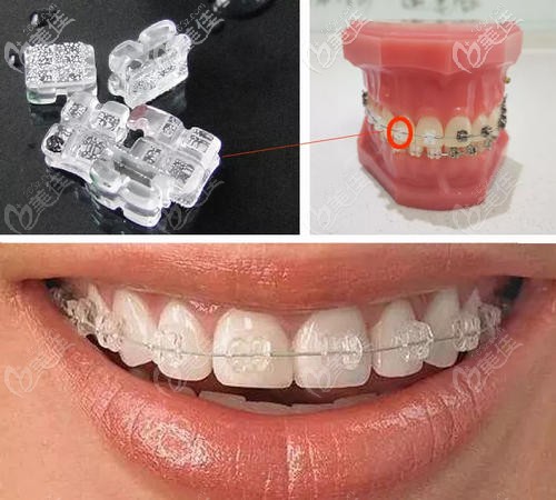 陶瓷托槽牙齒矯正