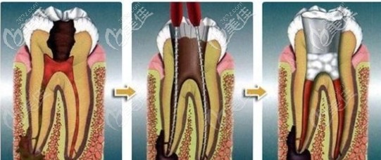牙齒有炎癥需要先治療