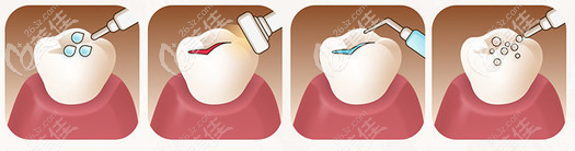 超聲波洗牙示意圖