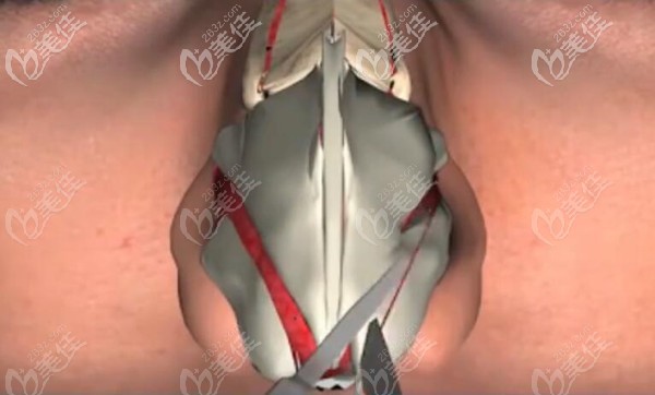 切除鼻大翼兩側(cè)的多余軟骨