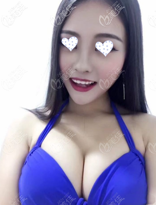 你自己看傲諾拉璀璨水滴假體250cc/290cc效果圖，胸大了3個罩杯