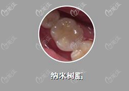 美國3M納米樹脂補牙價格