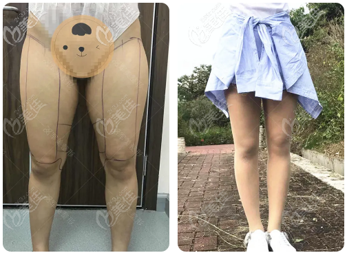 做腿部吸脂術(shù)大約多少錢？我做大腿抽脂肪花了14800多元