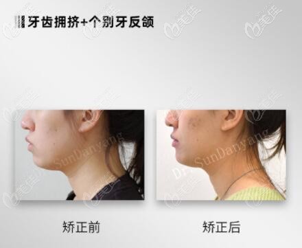 大連孫丹陽(yáng)牙齒擁擠+個(gè)別牙反頜矯正真人前后對(duì)比照