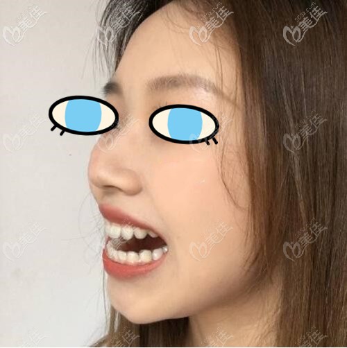 牙齒不齊導(dǎo)致嘴巴突出戴隱適美矯正有變化!才過了60天牙齒就端正了很多