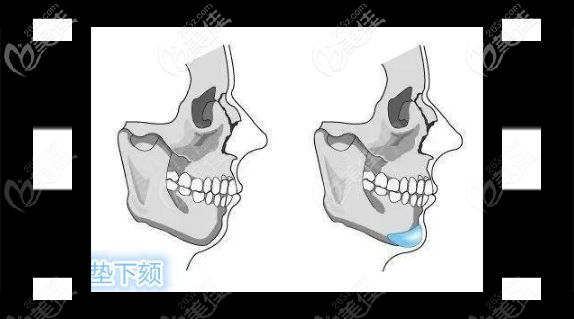 假體隆頦手術(shù)