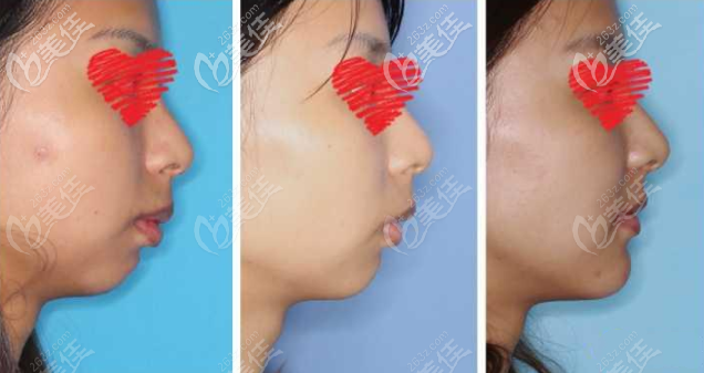 下巴后縮頦成型前移1厘米效果圖