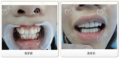 國(guó)產(chǎn)金屬自鎖牙齒矯正案例