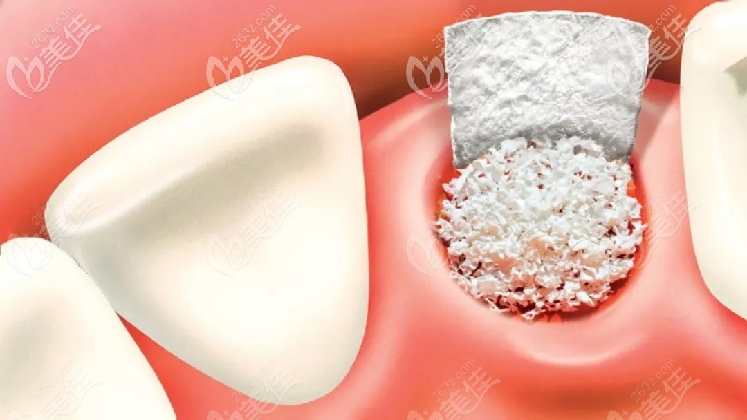 這是種植牙填入骨粉后的圖片