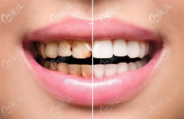 美白牙齒前后的效果對比圖