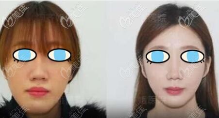 長(zhǎng)臉正頜手術(shù)變短臉真實(shí)案例效果圖片