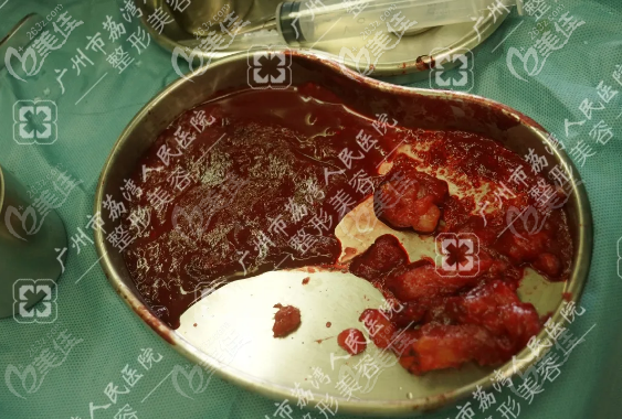 找齊云香做胸部奧美定取出手術(shù)靠譜