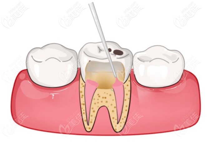 寧愿拔牙不做根管治療