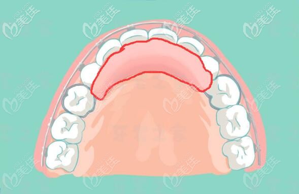 固定式平導(dǎo)
