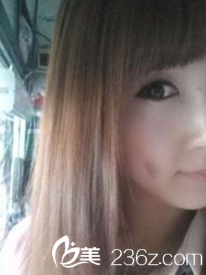 酒窩成型術(shù)