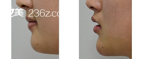 自體脂肪填充下巴