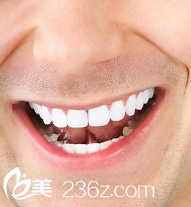 洗牙后注意事項(xiàng)